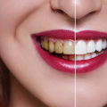 What is the Average Cost of Veneers at a Dentist's Office in Nashville, TN?
