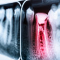 Root Canal Treatment in Nashville, TN: What You Need to Know