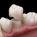 What is the Average Cost of a Root Canal in Nashville, TN?